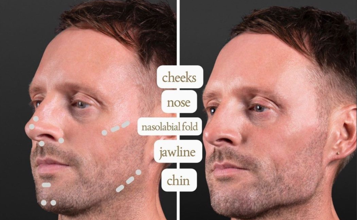 An ad for face 'masculinisation' surgery. Source: Instagram.